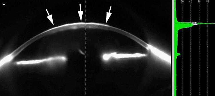 3-D View of anterior segment. ophthalmic cases, keratoplasty, laser assisted keratoplasty, femtosecond laser, Fuchs endothelial dystrophy, top hat